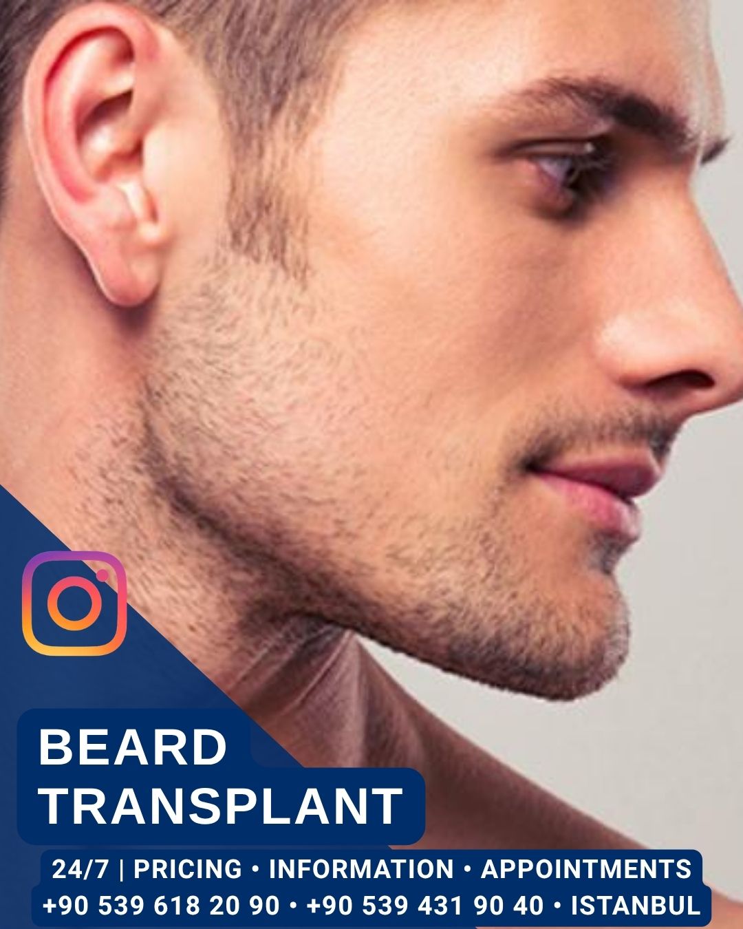 Home Beard Transplant
