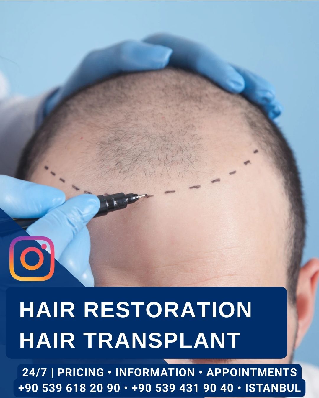Home Hair Restoration Hair Transplant