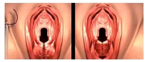 Permanent Hymenoplasty in Istanbul, Turkey how is permanent hymenoplasty (hymen repair surgery) performed in istanbul
