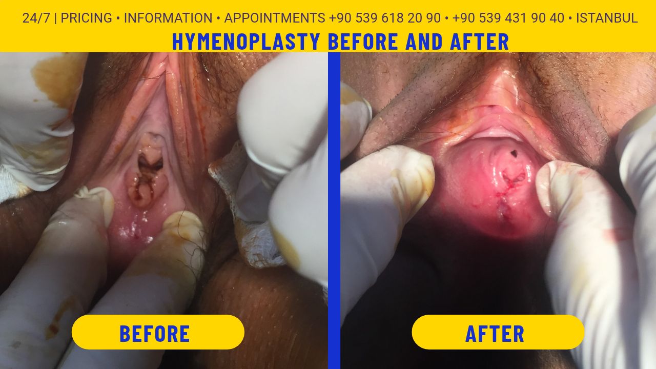 Hymenoplasty Before and After: What to Expect hymenoplasty before and after istanbul