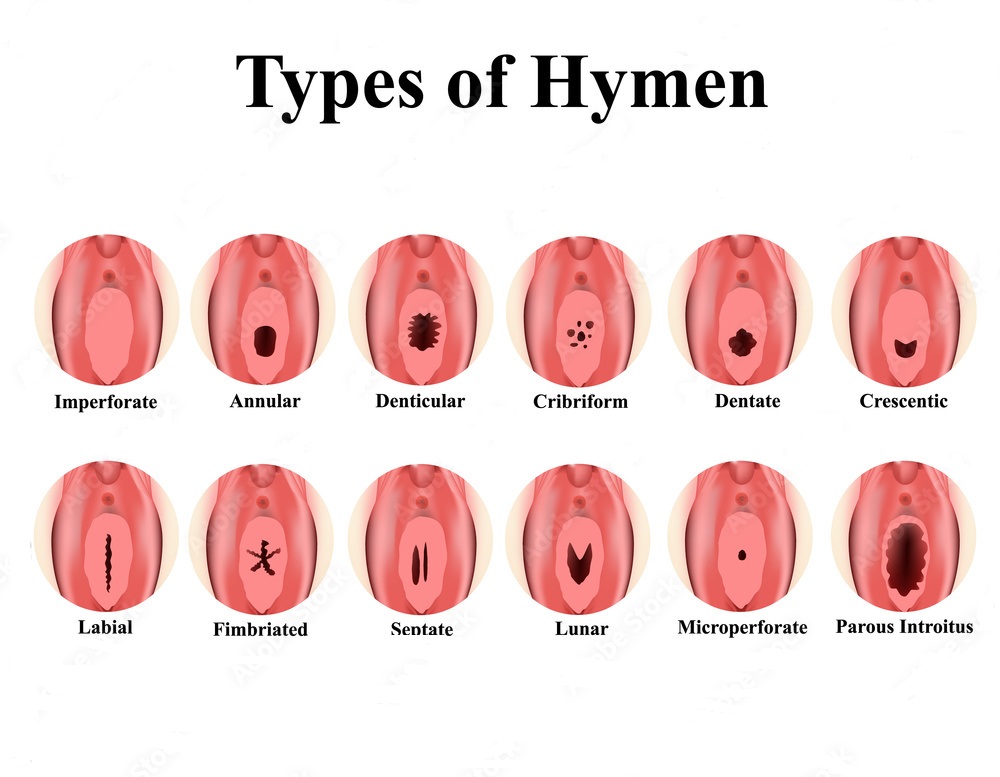 hymenoplasty recovery and aftercare (2)