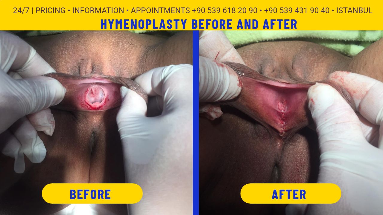 Permanent Hymenoplasty in Istanbul, Turkey permanent hymenoplasty surgery before and after istanbul, turkey