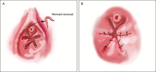 temporary hymenoplasty in istanbul